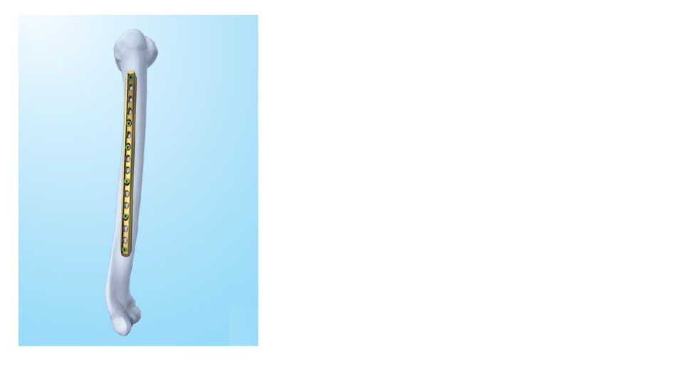 Placas de tibia proximal 